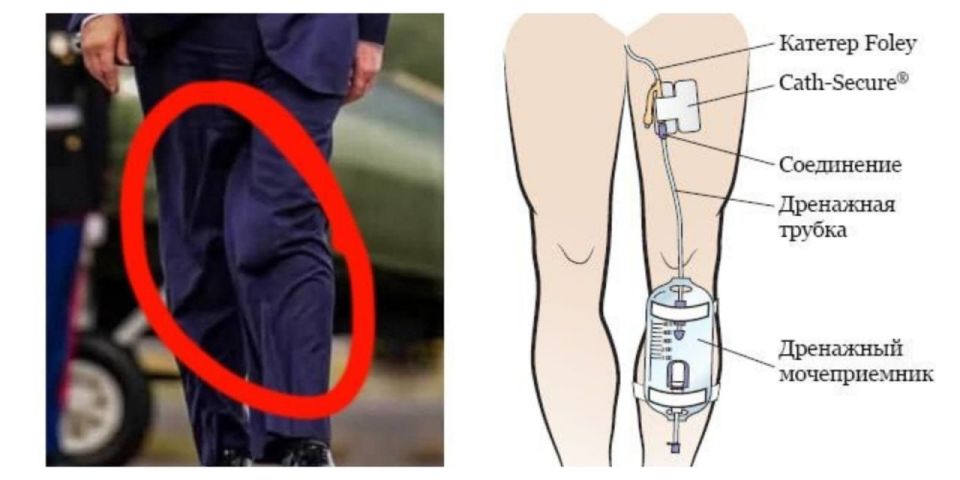 У Трампа во время ходьбы заметили торчащий из штанов мочесборник, примотанный к ноге